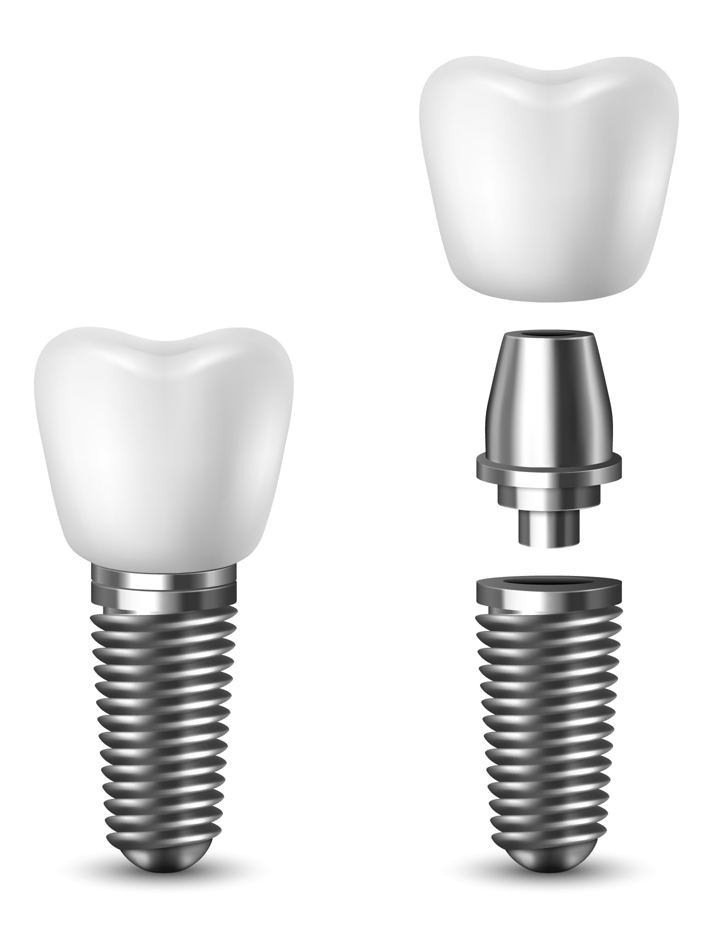 aba-dental-implant